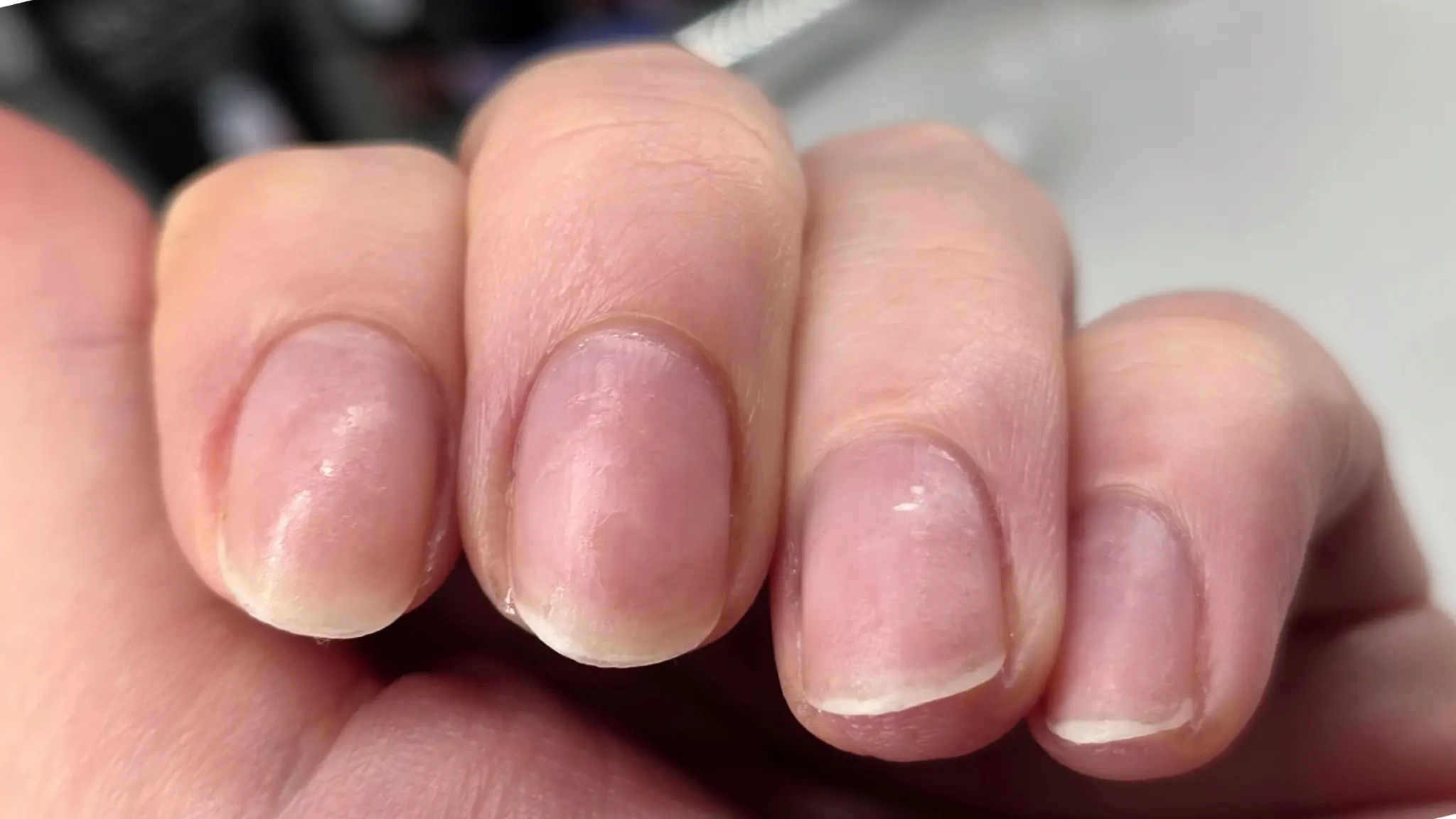 Healthy natural nails after safe gel polish removal showing temporary white appearance that is normal and resolves with cuticle oil application