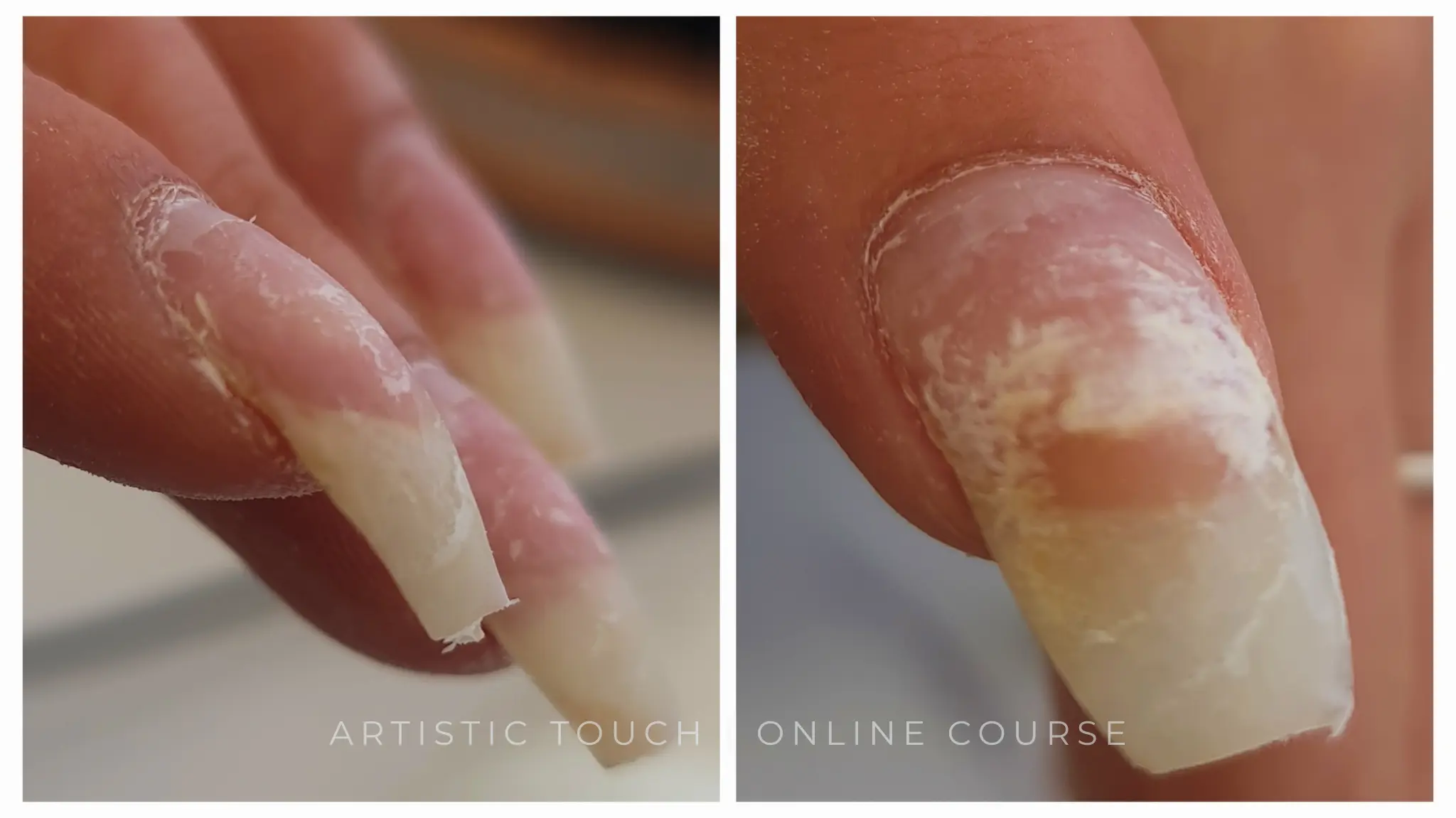 Hooked nail showing damage after removal of unsuitable BIAB overlay with lifting and separation